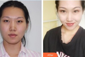 宜春愛爾眼科醫(yī)院陳文輝整形價格表附埋線雙眼皮案例展示