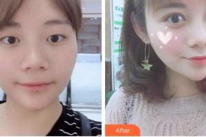 宜春愛爾眼科醫(yī)院任旋整形價(jià)格表附切開雙眼皮案例展示