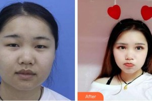 宜春愛爾眼科醫(yī)院楊甜整形價(jià)格表附切開雙眼皮案例展示