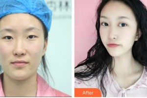 宜春愛爾眼科醫(yī)院譚成整形價(jià)格表附眼部綜合案例展示