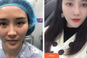 上饒尚美醫(yī)療美容門診部柯小洪整形價(jià)格表附眼部綜合案例展示