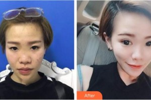 上饒平安醫(yī)院醫(yī)療美容科鄭黎敏整形價(jià)格表附眼部綜合案例展示