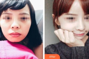 上饒尚美醫(yī)療美容門診部王先成整形價(jià)格表附鼻部綜合案例展示