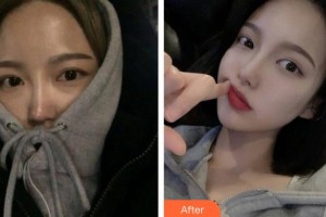 上饒尚美醫(yī)療美容門診部李海華整形價(jià)格表附鼻部綜合案例展示