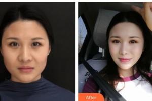 上饒尚美醫(yī)療美容門診部呂丹丹整形價(jià)格表附埋線提升案例展示