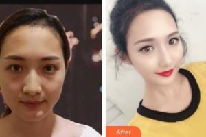 上饒韓美整形美容醫(yī)院黃陽整形價(jià)格表附超聲提拉案例展示