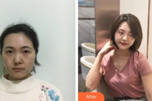 上饒肖發(fā)才醫(yī)療美容診所肖發(fā)才整形價(jià)格表附熱瑪吉案例展示