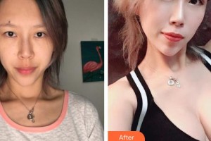 上饒尚美醫(yī)療美容門診部劉芳艷整形價(jià)格表附埋線提升案例展示