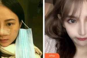 平頂山星美醫(yī)療美容門診部崔啟榮整形價格表附鼻部綜合案例展示