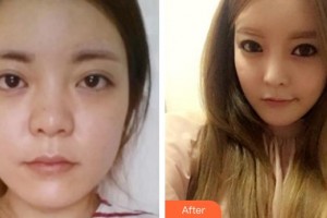 平頂山藝美醫(yī)療美容醫(yī)院王慧整形價(jià)格表附假體隆鼻案例展示