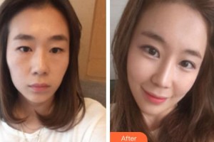 烏魯木齊子桐醫(yī)療美容診所李詠梅整形價格表附假體隆鼻案例展示