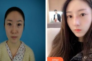 烏魯木齊美容學(xué)會整形美容門診部扈惠芝整形價格表附鼻部綜合案例展示