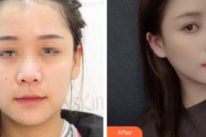 烏魯木齊美容學(xué)會整形美容門診部許黎整形價格表附鼻部綜合案例展示