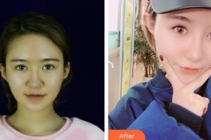 烏魯木齊黎美整形門診部張春亮整形價格表附隆鼻案例展示