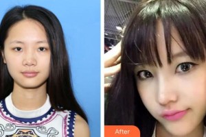 烏魯木齊伊麗莎白整形美容醫(yī)院李哲權(quán)整形價格表附假體隆鼻案例展示