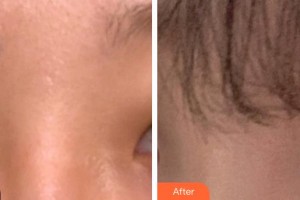 烏魯木齊藥業(yè)集團附屬醫(yī)院毛發(fā)種植科肖振鋒整形價格表附眼部綜合案例展示