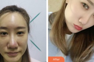 齊齊哈爾醫(yī)學院附屬第三醫(yī)院醫(yī)療美容科魏林平整形價格表附眼部綜合案例展示