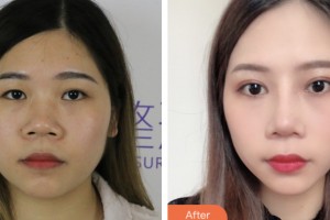 齊齊哈爾千百度整形美容醫(yī)院蔡里整形價格表附切開雙眼皮案例展示