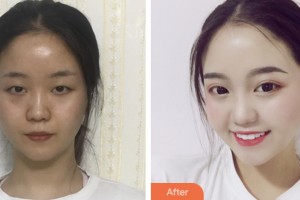 齊齊哈爾千百度整形美容醫(yī)院周冉整形價格表附眼部修復案例展示