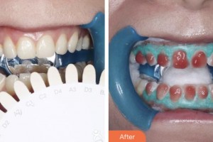 鹽城艾美莉整形美容醫(yī)院裔偉績整形價(jià)格表附美白劑美白牙齒案例展示