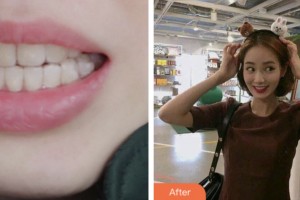 鹽城艾美莉整形美容醫(yī)院陳增喜整形價(jià)格表附超聲波潔牙案例展示