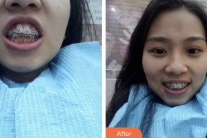 鹽城東方婦產(chǎn)醫(yī)院整形美容中心王武坤整形價(jià)格表附金屬托槽矯正案例展示