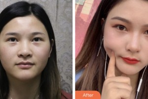 鹽城曙光愛爾眼科醫(yī)院程娟整形價(jià)格表附內(nèi)切祛眼袋案例展示