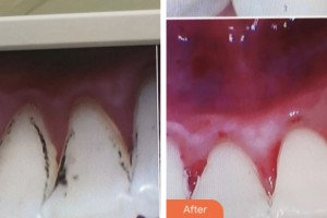 鹽城口腔醫(yī)院石開中整形價(jià)格表附超聲波潔牙案例展示