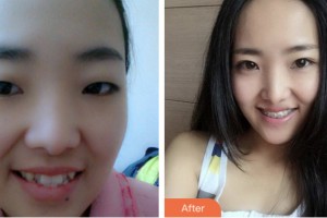 鹽城倍美永康口腔門診部洪瑛瑛住院醫(yī)師整形價(jià)格表附金屬托槽矯正案例展示