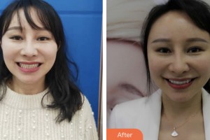 鹽城倍美永康口腔門診部浦寅飛整形價(jià)格表附牙貼面案例展示