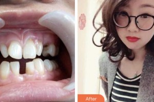 鹽城倍美永康口腔門診部唐士芹整形價(jià)格表附牙齒隱形矯正案例展示