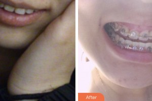 鹽城倍美永康口腔門診部仇靜靜整形價(jià)格表附金屬托槽矯正案例展示