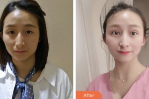 鹽城朝聚眼科醫(yī)院胡恩海整形價(jià)格表附切開雙眼皮案例展示