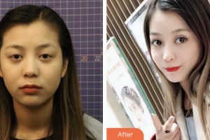 鹽城朝聚眼科醫(yī)院鄭晨超整形價(jià)格表附切開雙眼皮案例展示