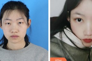 鹽城朝聚眼科醫(yī)院周羽整形價(jià)格表附眼部綜合案例展示