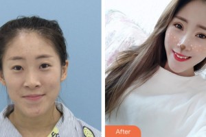 鹽城朝聚眼科醫(yī)院駱亞東整形價(jià)格表附眼部綜合案例展示