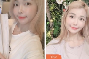 鹽城朝聚眼科醫(yī)院和大力整形價(jià)格表附切開雙眼皮案例展示