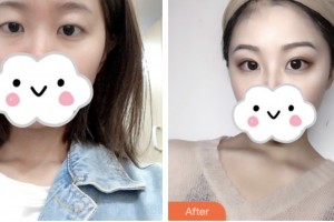 淮安第二人民醫(yī)院整形美容外科陳伏庭整形價格表附切開雙眼皮案例展示