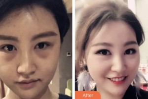 淮安第二人民醫(yī)院整形美容外科陳文斌整形價格表附內切祛眼袋案例展示