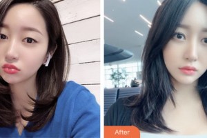 淮安第一人民醫(yī)院整形美容外科封必釗整形價格表附切開雙眼皮案例展示