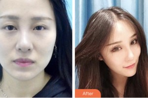 淮安市婦幼保健院醫(yī)療美容科李岳令住院醫(yī)師整形價格表附切開雙眼皮案例展示