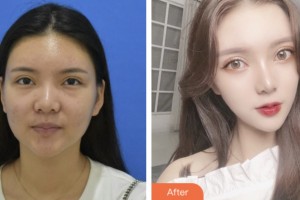 淮安市婦幼保健院醫(yī)療美容科王川穎整形價格表附激光去眼袋案例展示