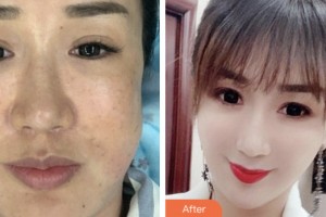 淮安華美整形外科醫(yī)院耿麗紅整形價格表附埋線提升案例展示