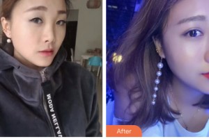 淮安俏美整形美容醫(yī)院朱逸整形價格表附熱瑪吉案例展示