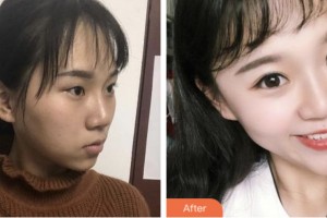 淮安光明眼科醫(yī)院劉鳳整形價(jià)格表附切開(kāi)雙眼皮案例展示