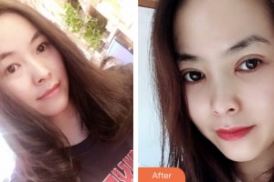 淮安光明眼科醫(yī)院姜蘇整形價(jià)格表附切開(kāi)雙眼皮案例展示