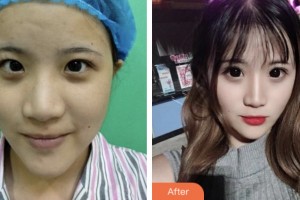 婁底美科醫(yī)療美容門診部（原婁底華美整形美容醫(yī)院）姜昌君整形價(jià)格表附切開(kāi)雙眼皮案例展示