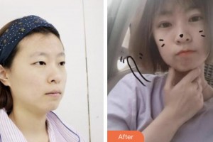 婁底市中醫(yī)院燒傷整形科鄧建光整形價(jià)格表附切開(kāi)雙眼皮案例展示