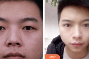 婁底市中心醫(yī)院整形美容科劉自飛整形價(jià)格表附切開(kāi)雙眼皮案例展示