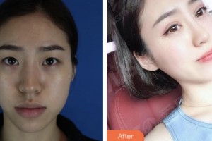婁底京都醫(yī)學(xué)整形醫(yī)院鄧小麗整形價(jià)格表附眼部綜合案例展示